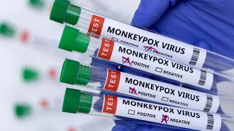 Man with no history of foreign travel tests positive for monkeypox in Delhi  - India News